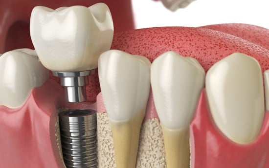 Medically accurate example of dental implants in Midland, MI